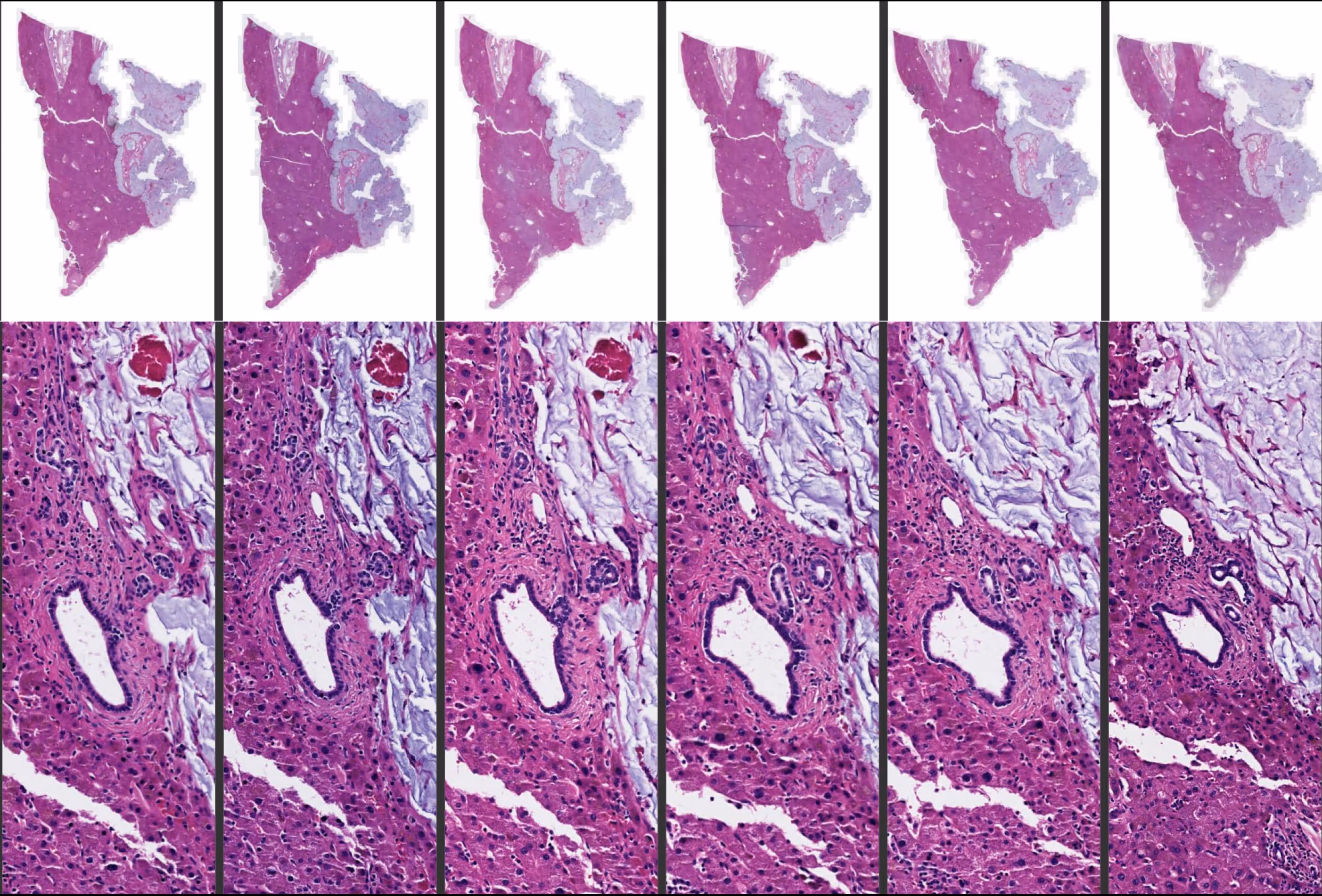 Skylab™ Dewax and H&E Kit: 6 serial sections of FFPE liver tumour. Stained with the Skylab H&E kit